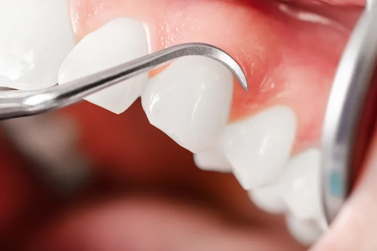 Gums Dental Treatment