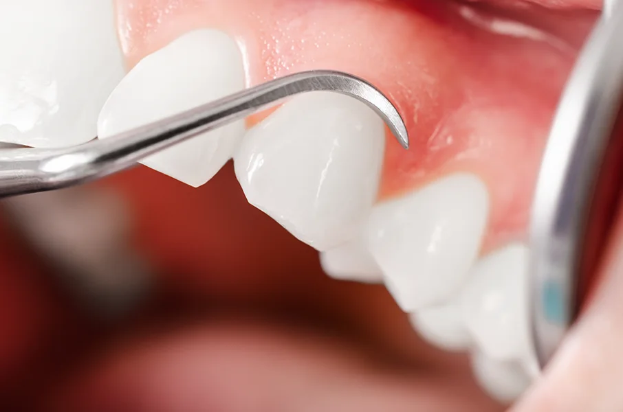 Gums Dental Treatment
