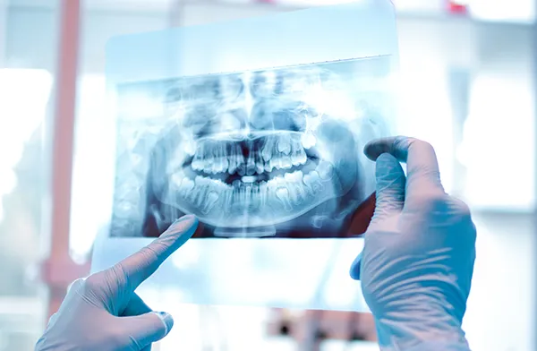 Wisdom tooth removal