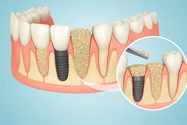 Bone Graft