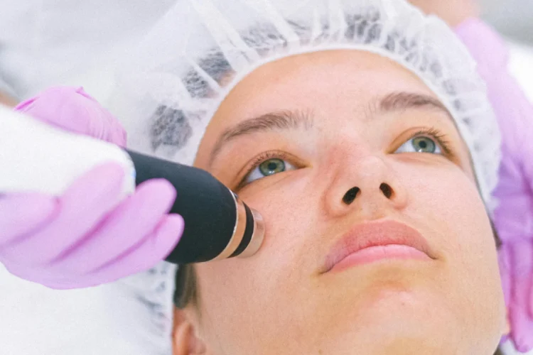 Face Rejuvenation with SmoothLase
